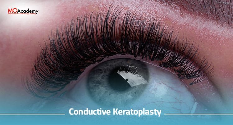 conductive keratoplasty near me