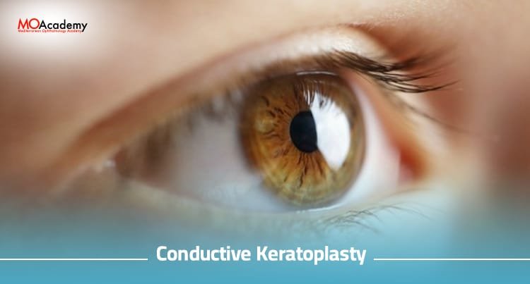 conductive keratoplasty