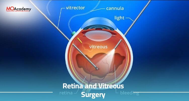 vitreous retinal surgery